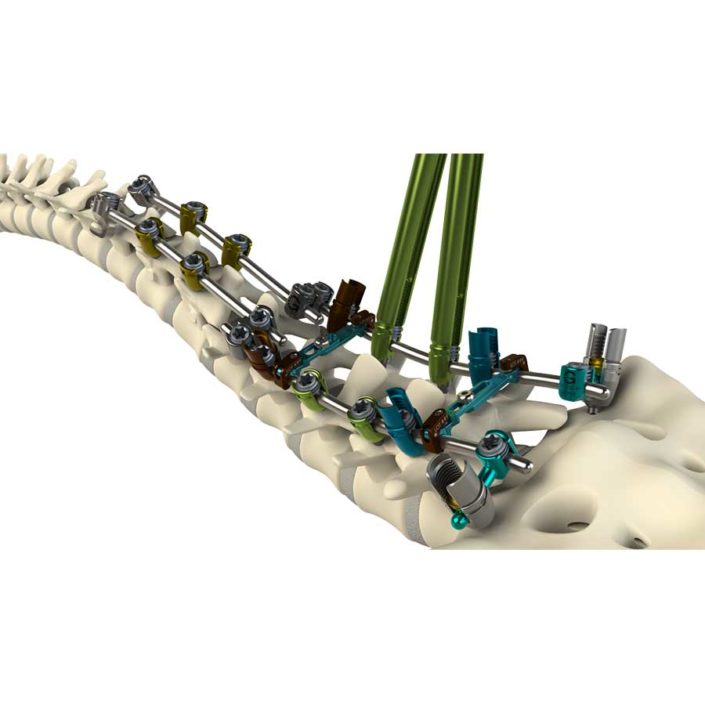 TiLock2 Spinal System