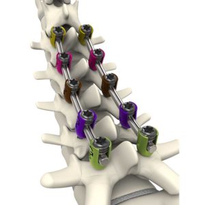 TiLock Cortical Spinal System