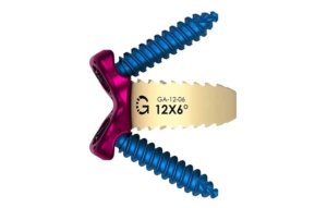 Binary Lumbar Plate System