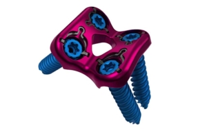 Binary Lumbar Plate System