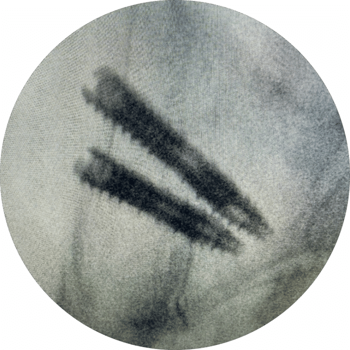 Oblique Sacroiliac Joint Fusion – SIros O 3D Printed - Genesys Spine